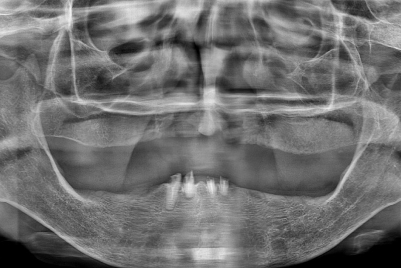 고령-환자-전체-임플란트-치료-전-X-ray.jpg