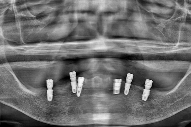 전체-임플란트-하악-임플란트-6개-식립-후-X-ray.jpg