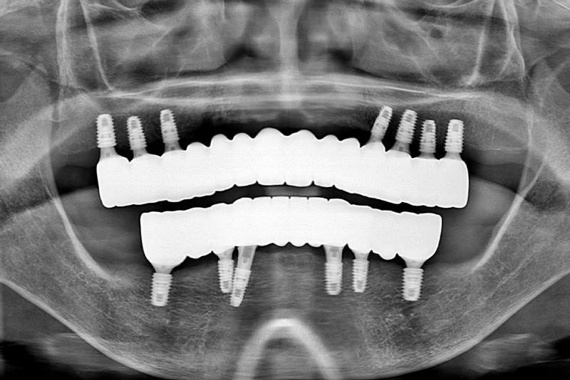 전체-임플란트-14개-최종-파노라마-X-ray.jpg