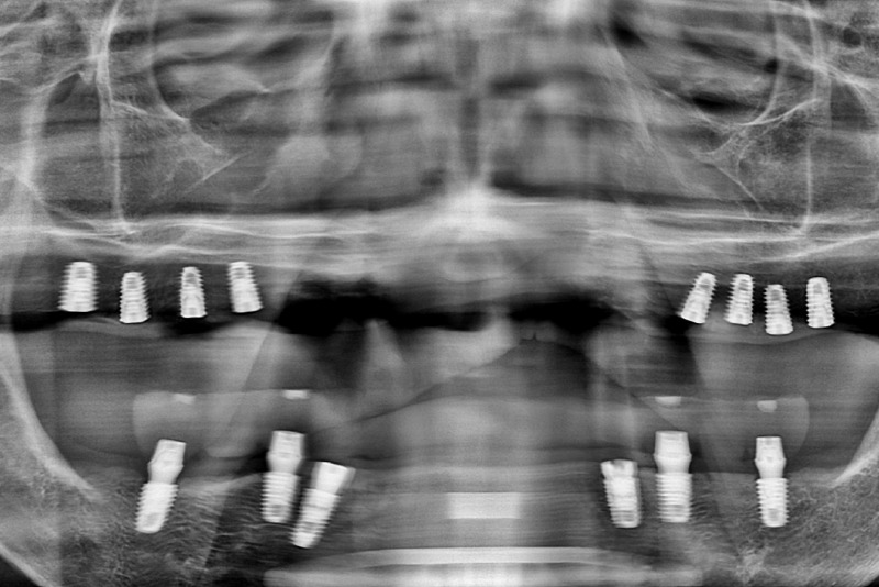 전체-임플란트-상악-임플란트-8개-식립-후-X-ray.jpg